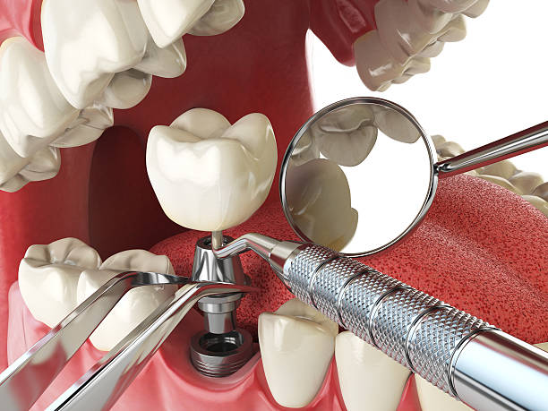 Best Emergency Dentist for Knocked-Out Tooth in USA